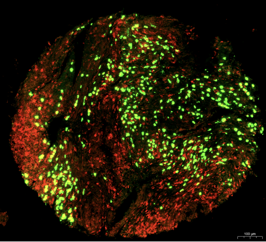 Eosinophils in colorectal cancer