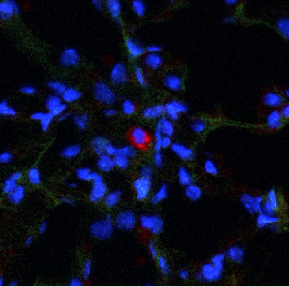 Immunofluorescent image of a single, dormant breast cancer cell (red) disseminated to the lung (courtesy Héctor Castañón)